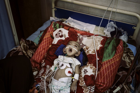 fot. Lorenzo Tugnoli, Contrasto (dla Washington Post), z cyklu the Yemen Crisis, Nominacja do nagrody World Press Photo Story of the Year

Po niemal 4 latach konfliktu w Jemenie, przynajmniej 8,4 mln osób zagrożonych jest głodem, a 22 miliony (75% populacji) wymaga pomocy humanitarnej.  
W 2014 roku muzułmańscy rebelianci Houthi Shia oblężyły północ kraju, zmuszając prezydenta Abdrabbuha Mansoura Hadiego do ustąpienia ze stanowiska. Konflikt rozprzestrzenił się gdy Arabia Saudyjska w koalicji z innymi państwami sunnickimi rozpoczęła naloty na pozycje Houthi. Do 2018 roku doprowadziło to jednej największych katastrof humanitarnych naszych czasów. 