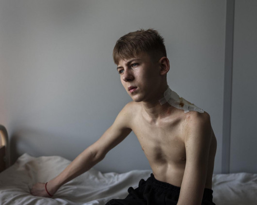 fot. Tomasz Lazar, 1. miejsce w kat. Single / People 29 kwietnia doszło do ostrzału. 15-letni Igor z Siewierska usłyszał wybuch i zaczął biec, aby się
schować. „Nie zdążyłem, dosięgła mnie fala uderzeniowa. Straciłem na chwilę przytomność. Kiedy się
ocknąłem, mocno krwawiłem". Zaniesiono go do piwnicy, później przewieziono do szpitala w
Bachmucie, a następnie do Lwowa.